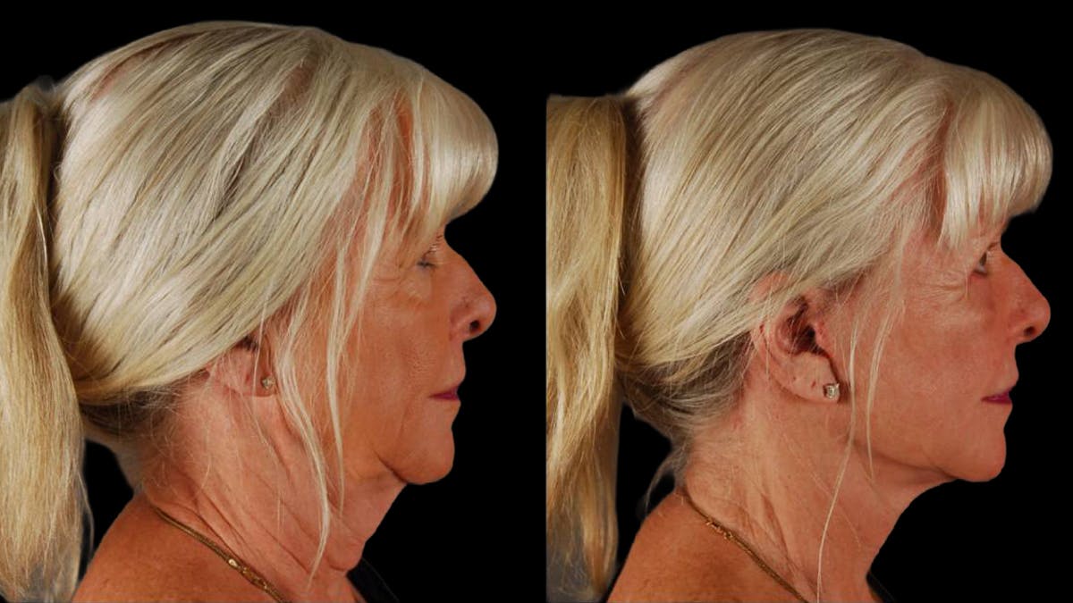 Neck Lift Before & After Gallery - Patient 955838 - Image 3
