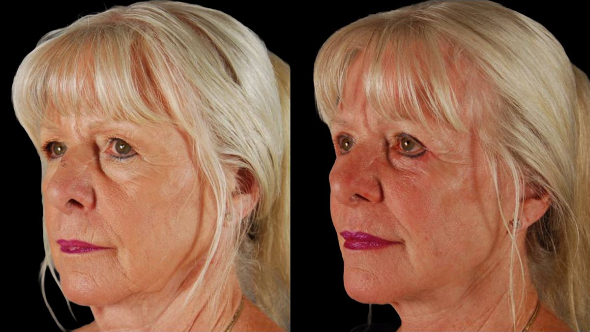 Neck Lift Before & After Gallery - Patient 955838 - Image 4