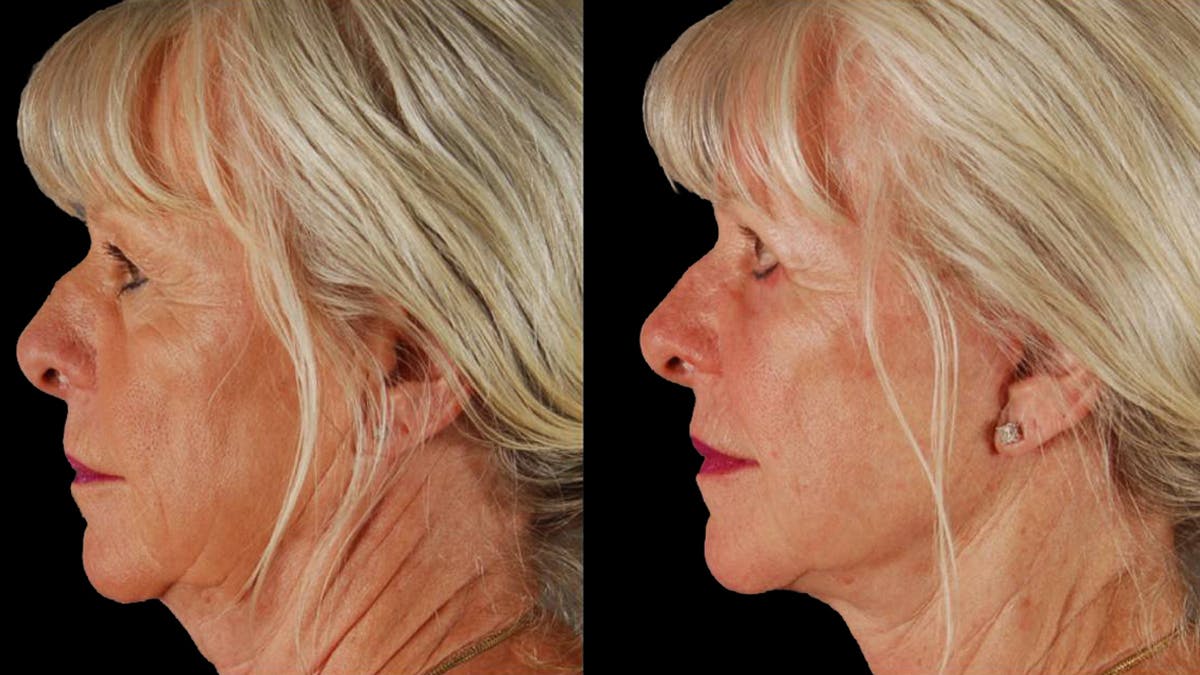 Neck Lift Before & After Gallery - Patient 955838 - Image 5