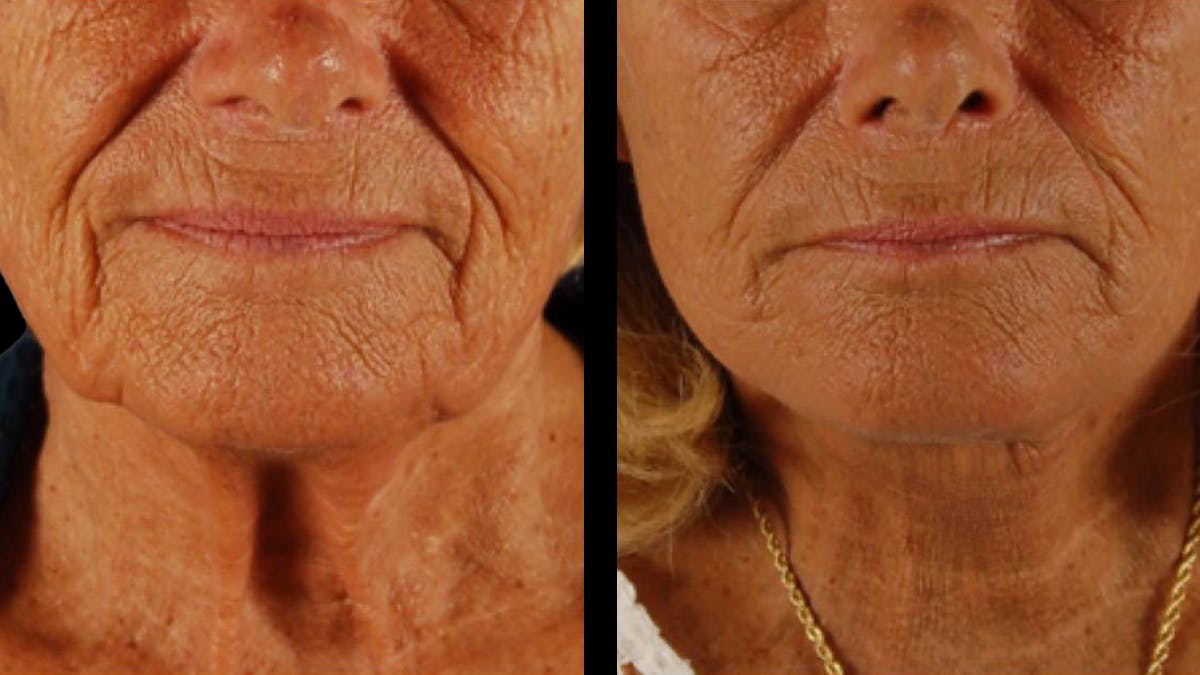 Deep Plane Facelift Before & After Gallery - Patient 357773 - Image 10