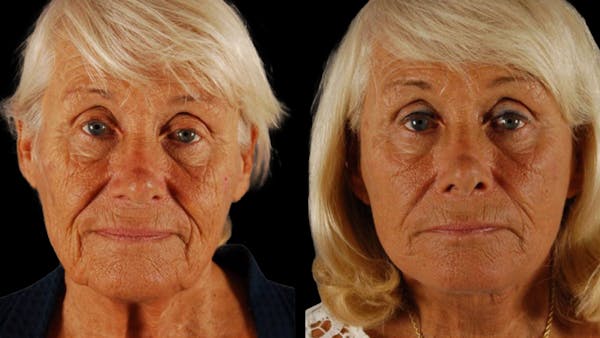 Deep Plane Facelift Before & After Gallery - Patient 357773 - Image 1