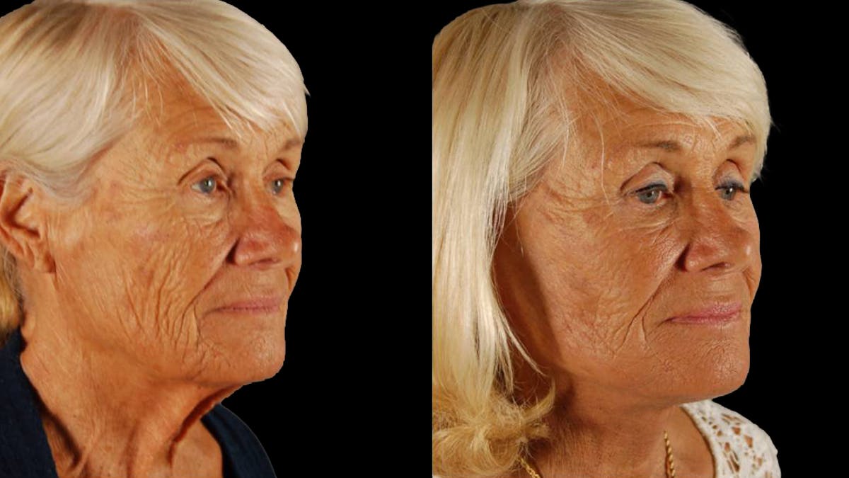 Deep Plane Facelift Before & After Gallery - Patient 357773 - Image 2