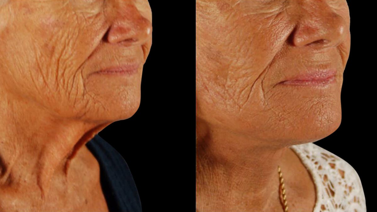 Deep Plane Facelift Before & After Gallery - Patient 357773 - Image 3