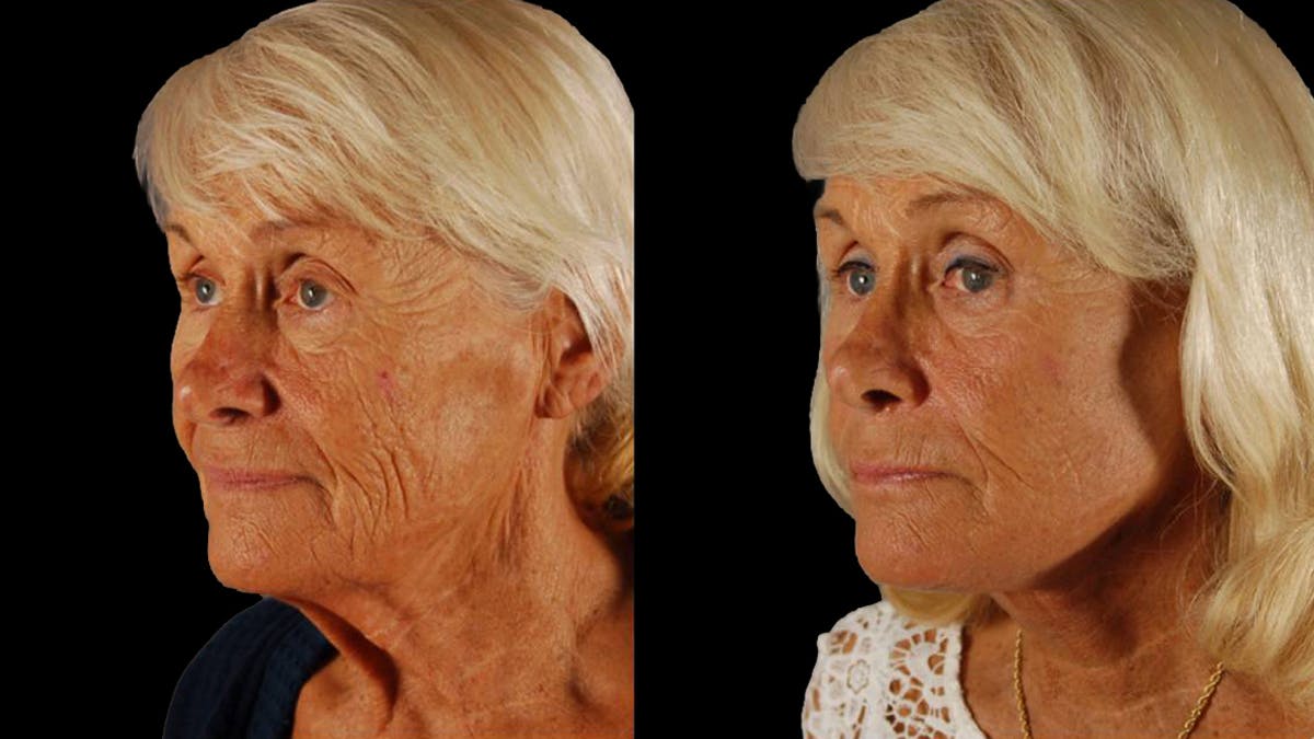 Deep Plane Facelift Before & After Gallery - Patient 357773 - Image 4
