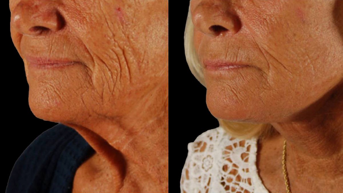 Deep Plane Facelift Before & After Gallery - Patient 357773 - Image 5