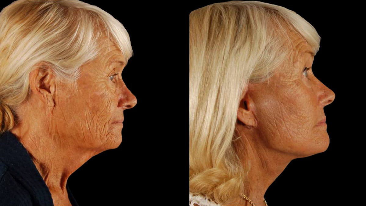 Deep Plane Facelift Before & After Gallery - Patient 357773 - Image 6