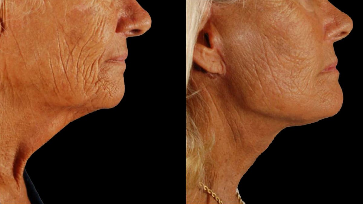 Deep Plane Facelift Before & After Gallery - Patient 357773 - Image 7