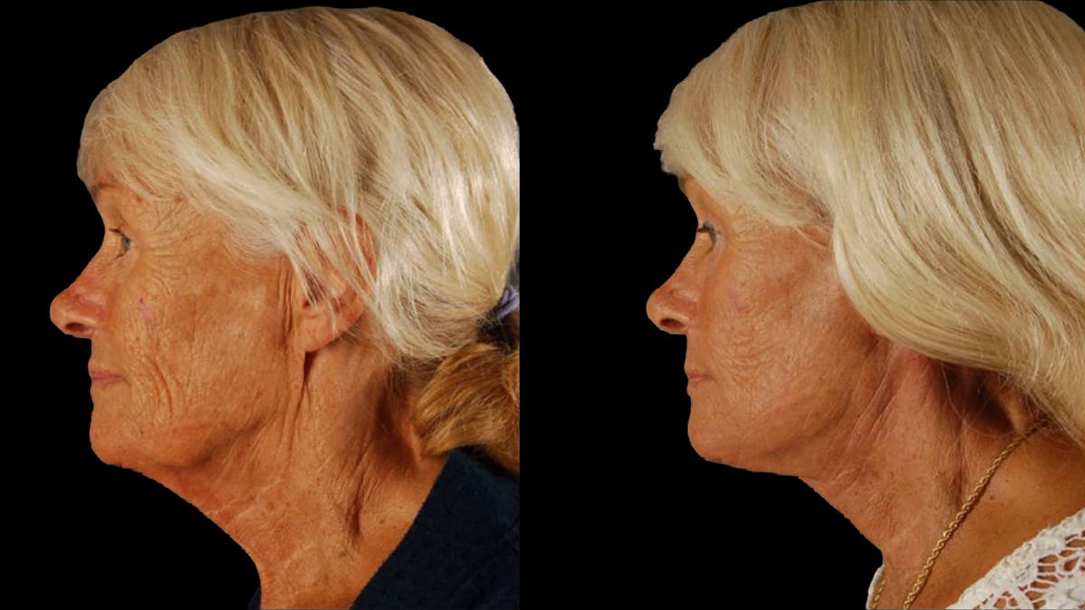 Deep Plane Facelift Before & After Gallery - Patient 357773 - Image 8