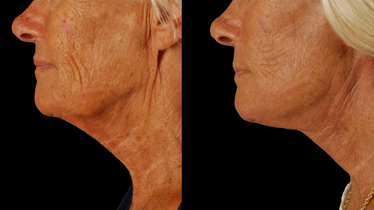 Deep Plane Facelift Before & After Gallery - Patient 357773 - Image 9
