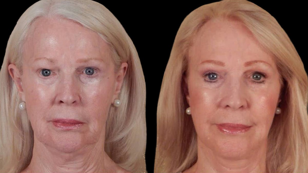 Deep Plane Facelift Before & After Gallery - Patient 104196 - Image 1