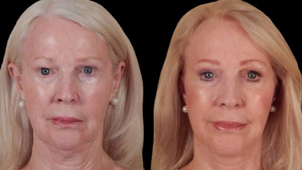Deep Plane Facelift Before & After Gallery - Patient 104196 - Image 1