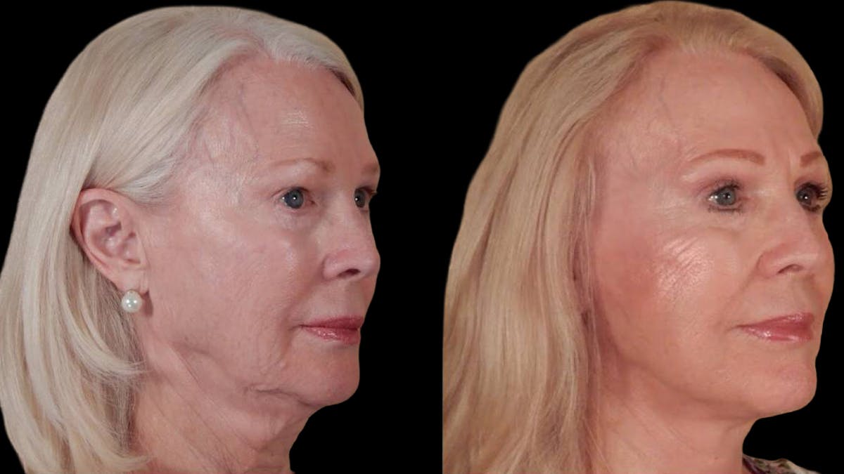 Deep Plane Facelift Before & After Gallery - Patient 104196 - Image 2