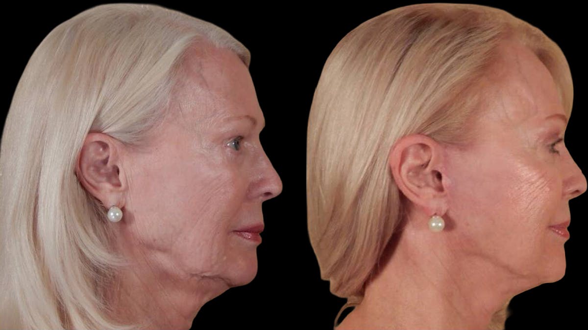 Deep Plane Facelift Before & After Gallery - Patient 104196 - Image 3