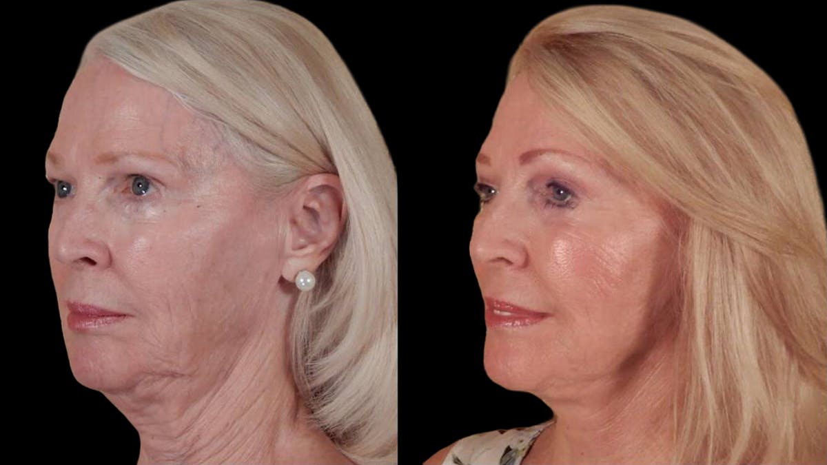 Deep Plane Facelift Before & After Gallery - Patient 104196 - Image 4