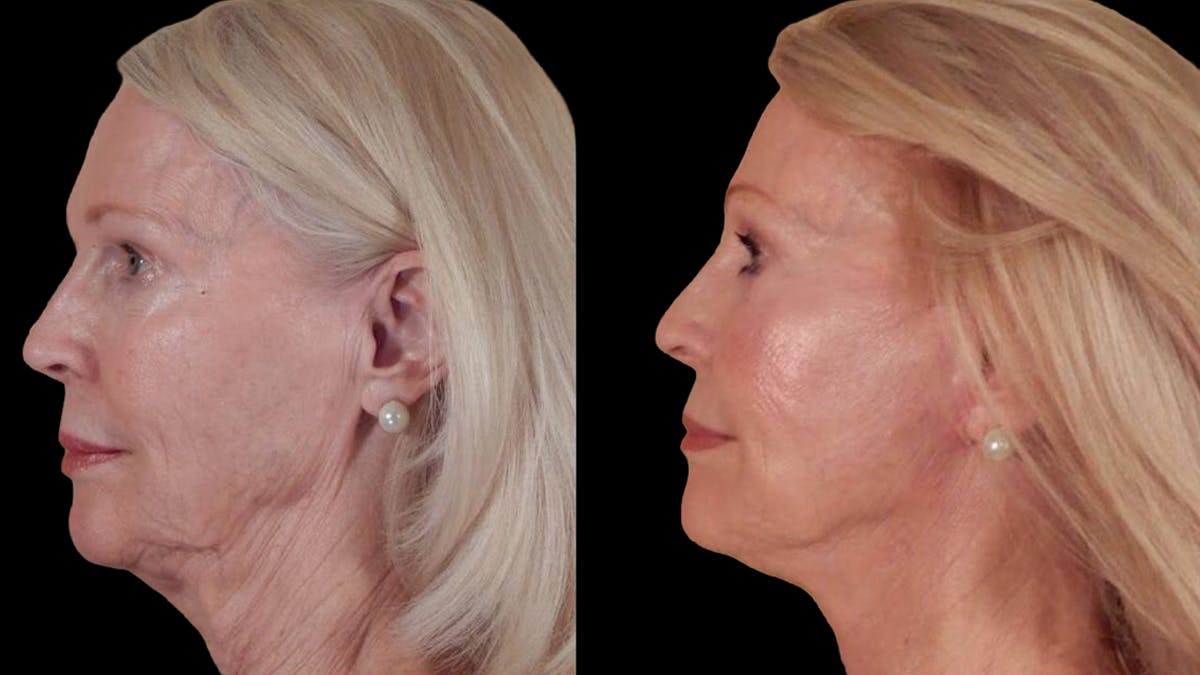 Deep Plane Facelift Before & After Gallery - Patient 104196 - Image 5