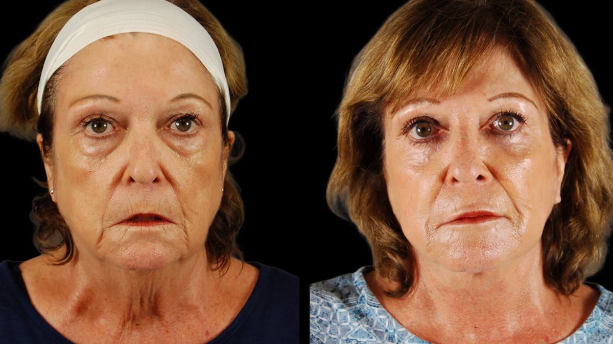 Deep Plane Facelift Before & After Gallery - Patient 216451 - Image 1