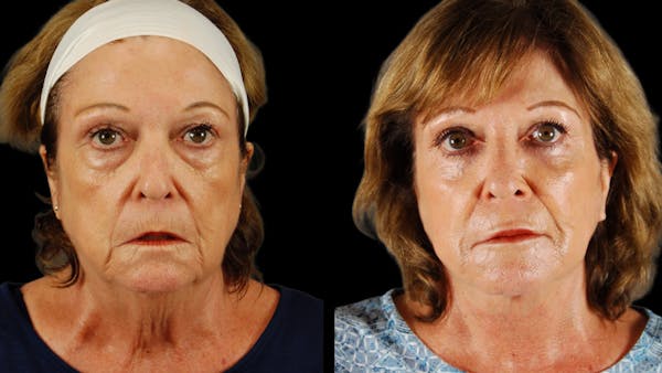 Deep Plane Facelift Before & After Gallery - Patient 216451 - Image 1