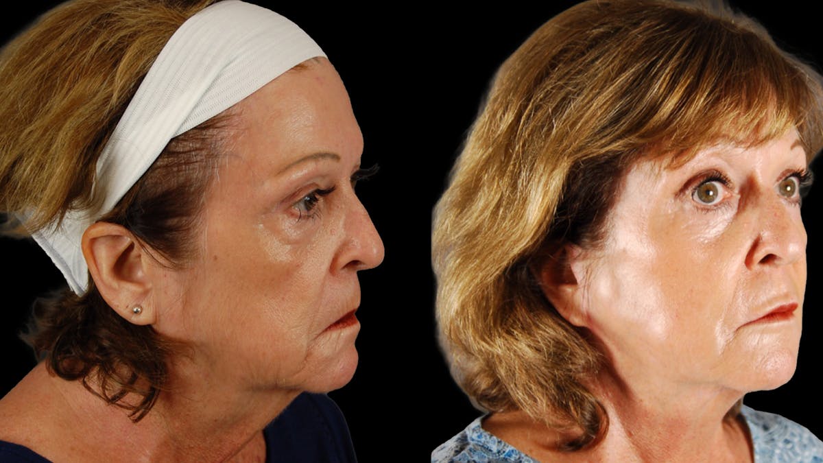 Deep Plane Facelift Before & After Gallery - Patient 216451 - Image 2