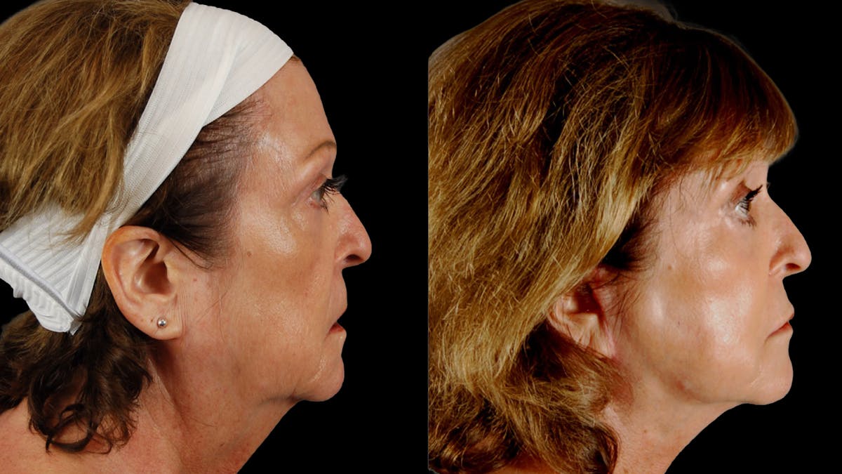 Deep Plane Facelift Before & After Gallery - Patient 216451 - Image 3