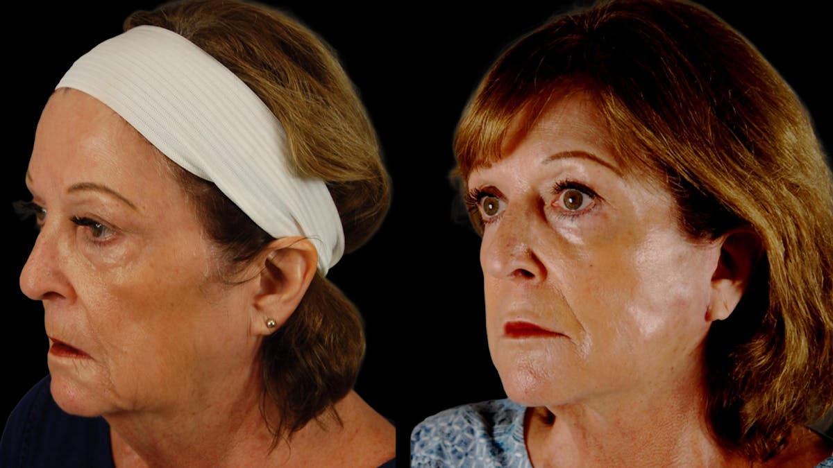 Deep Plane Facelift Before & After Gallery - Patient 216451 - Image 4