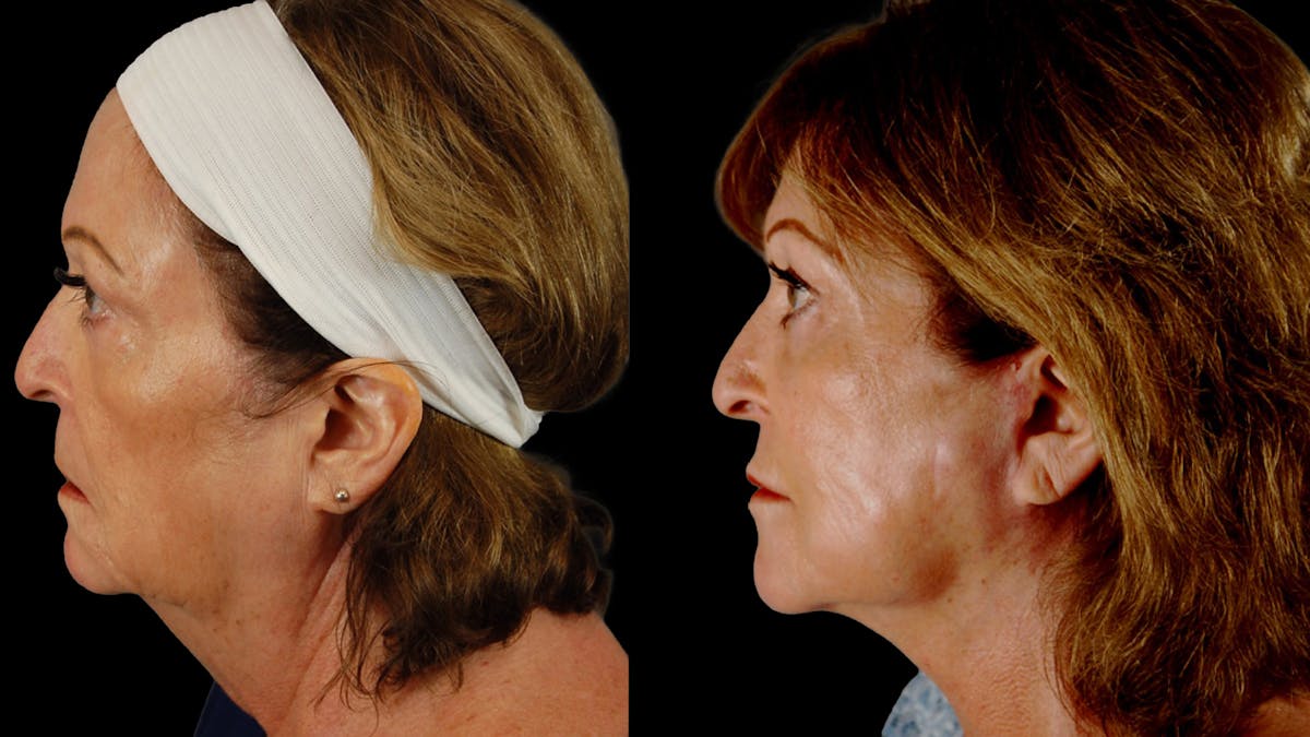 Deep Plane Facelift Before & After Gallery - Patient 216451 - Image 5