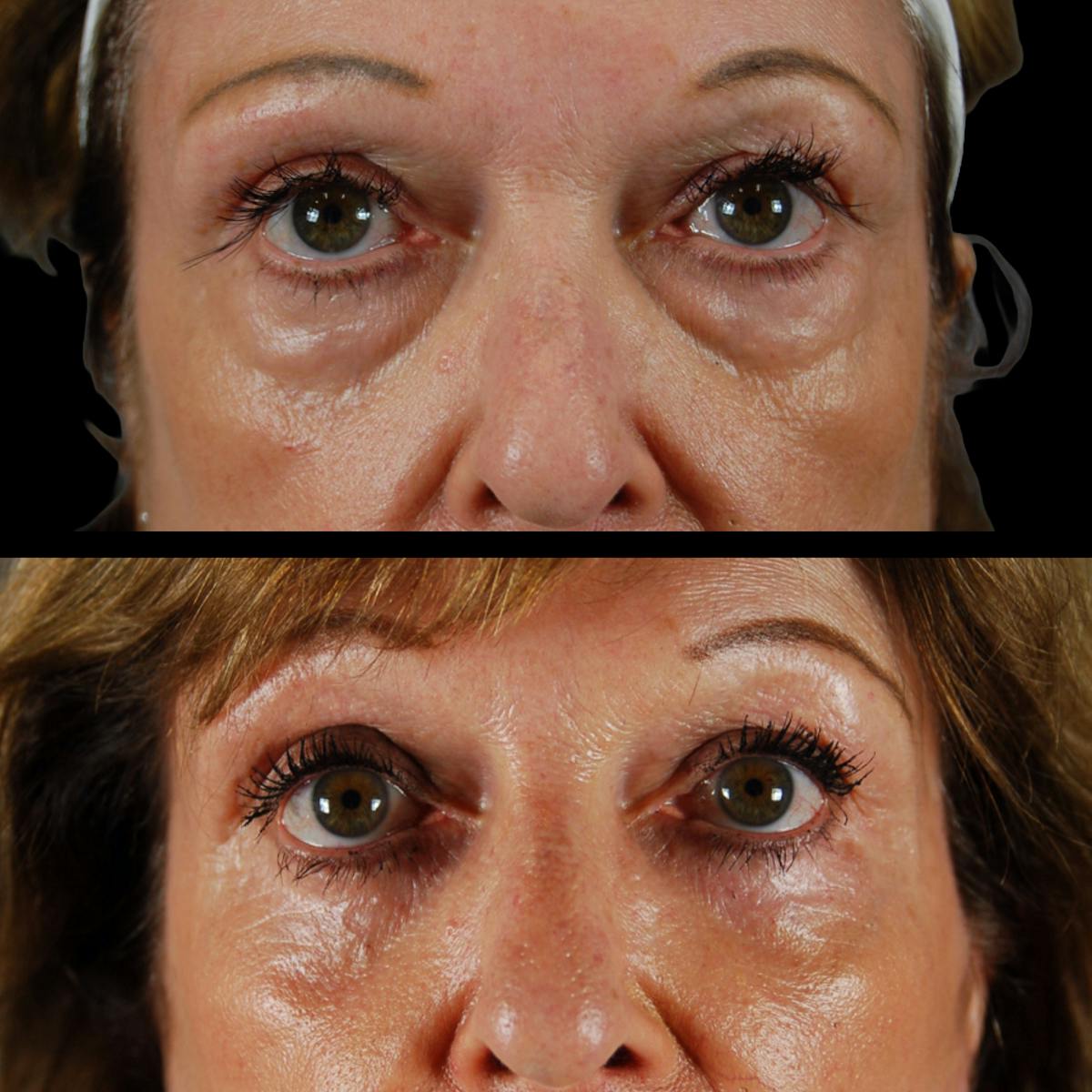 Deep Plane Facelift Before & After Gallery - Patient 216451 - Image 6