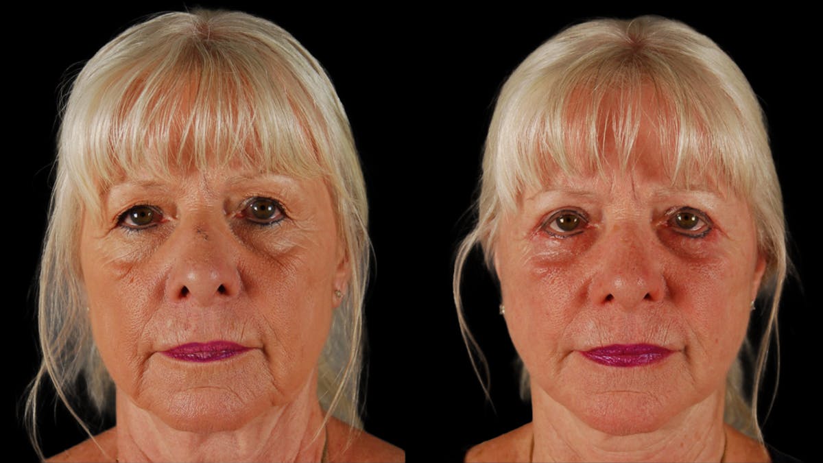 Deep Plane Facelift Before & After Gallery - Patient 116700 - Image 1