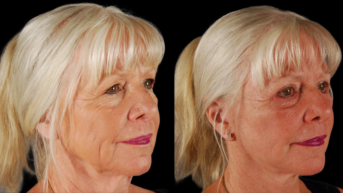 Deep Plane Facelift Before & After Gallery - Patient 116700 - Image 2