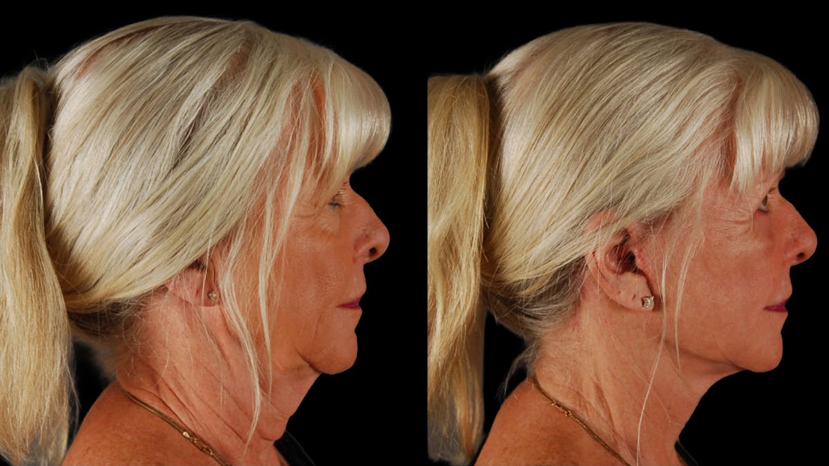 Deep Plane Facelift Before & After Gallery - Patient 116700 - Image 3