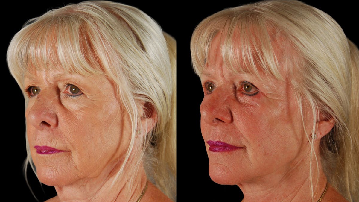 Deep Plane Facelift Before & After Gallery - Patient 116700 - Image 4