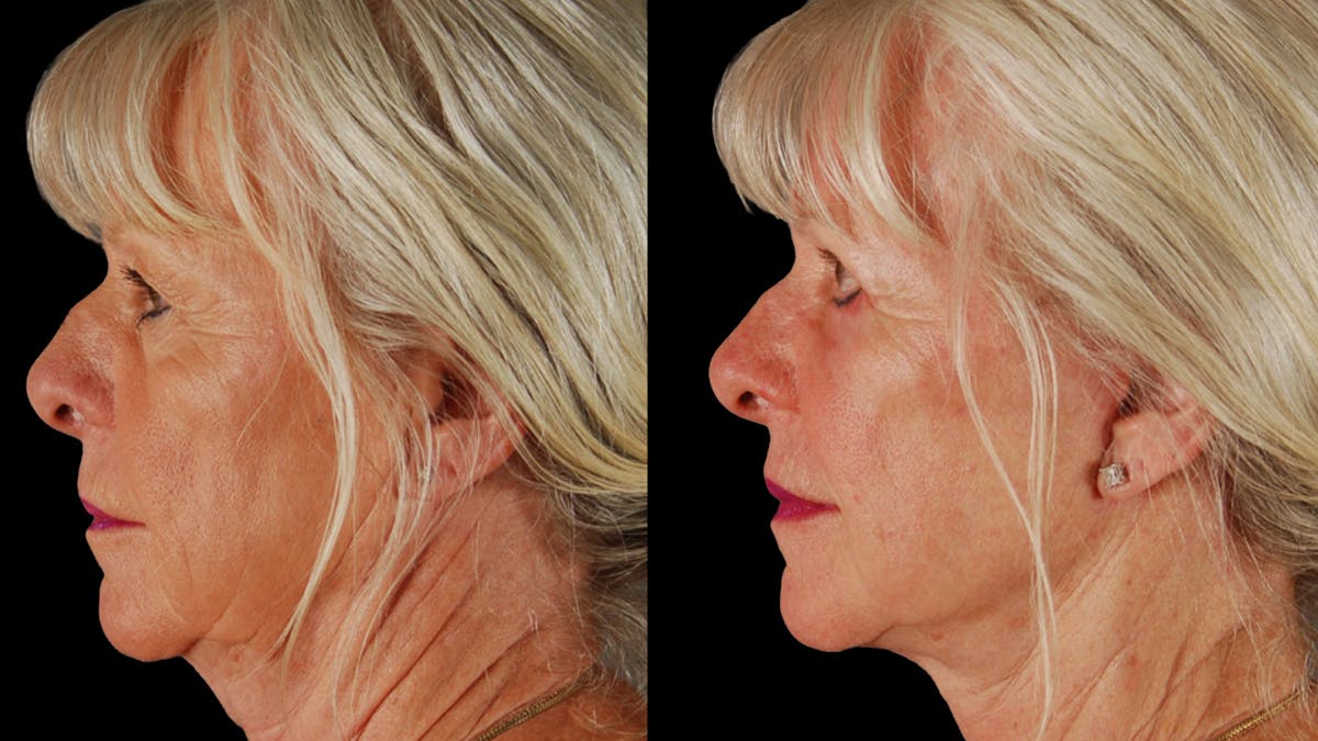 Deep Plane Facelift Before & After Gallery - Patient 116700 - Image 5