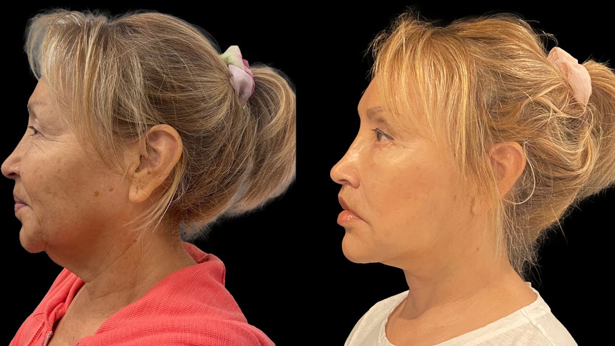 Deep Plane Facelift Before & After Gallery - Patient 824283 - Image 2