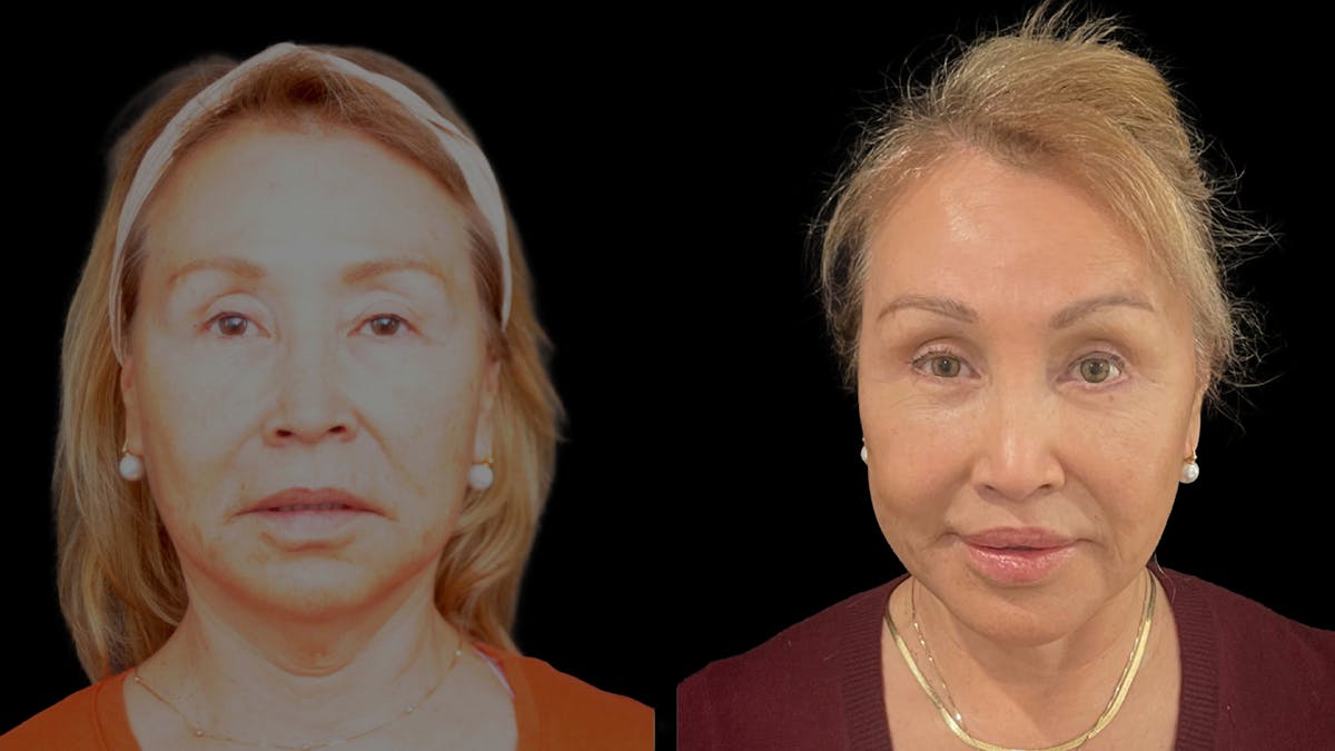 Deep Plane Facelift Before & After Gallery - Patient 824283 - Image 3