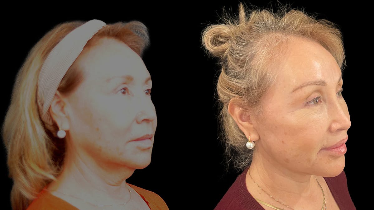 Deep Plane Facelift Before & After Gallery - Patient 824283 - Image 4