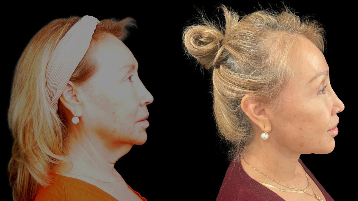 Deep Plane Facelift Before & After Gallery - Patient 824283 - Image 5