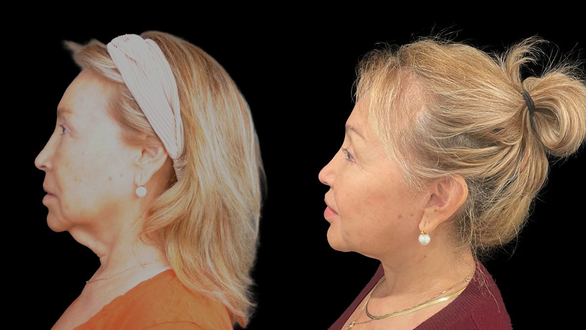 Deep Plane Facelift Before & After Gallery - Patient 824283 - Image 6