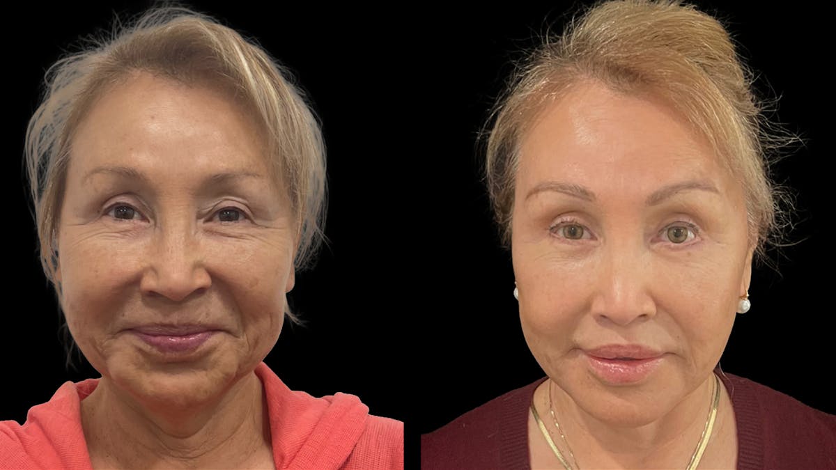 Deep Plane Facelift Before & After Gallery - Patient 824283 - Image 1