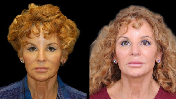 Deep Plane Facelift Before & After Gallery - Patient 154377 - Image 1