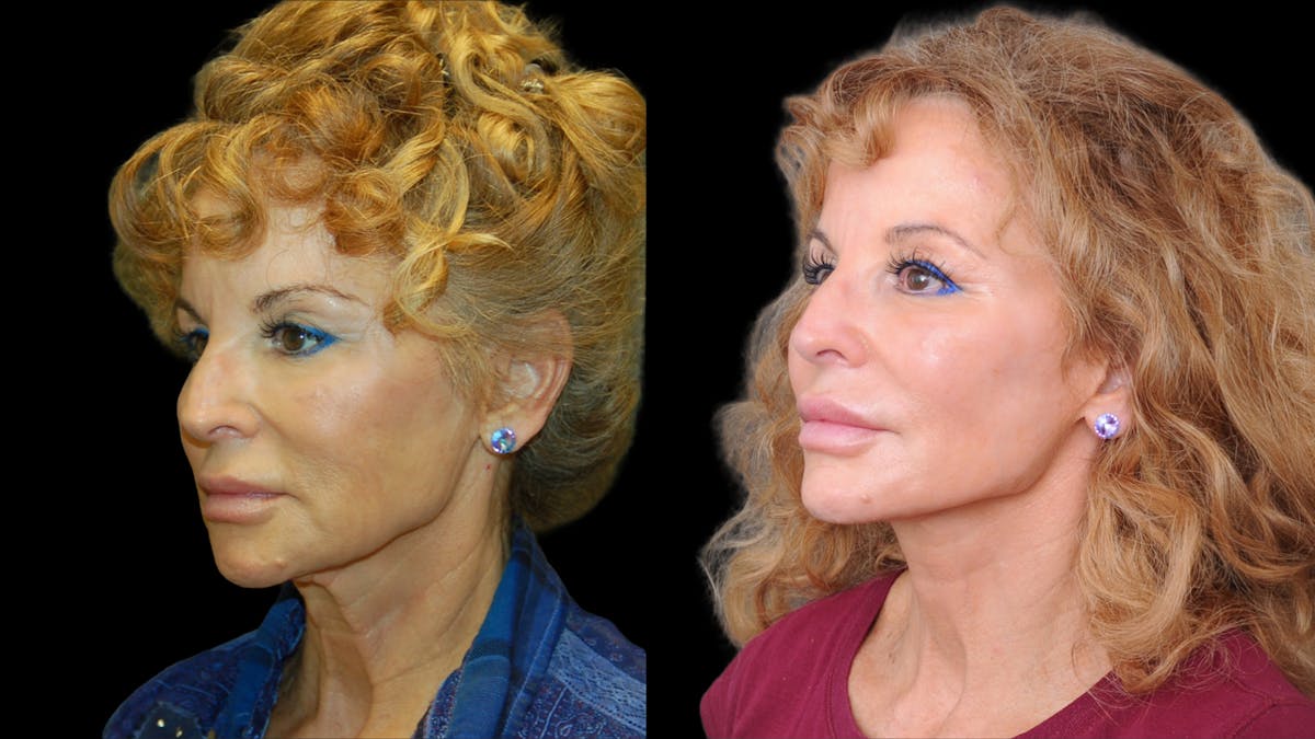 Deep Plane Facelift Before & After Gallery - Patient 154377 - Image 2