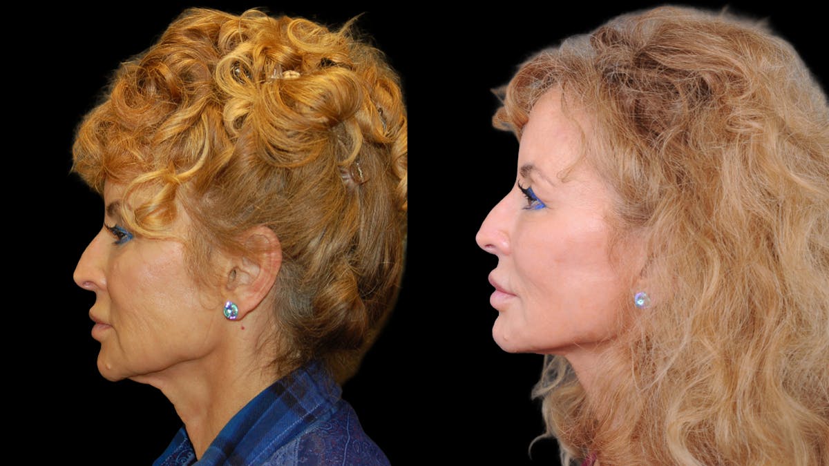 Deep Plane Facelift Before & After Gallery - Patient 154377 - Image 3