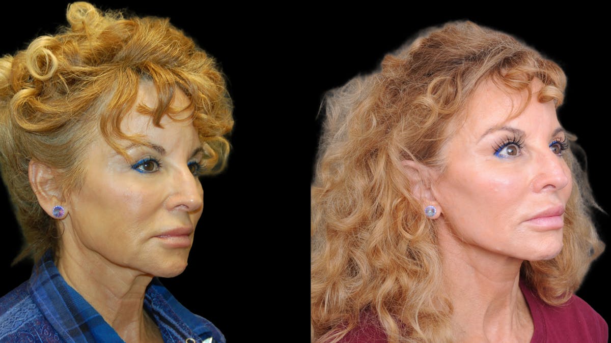 Deep Plane Facelift Before & After Gallery - Patient 154377 - Image 4
