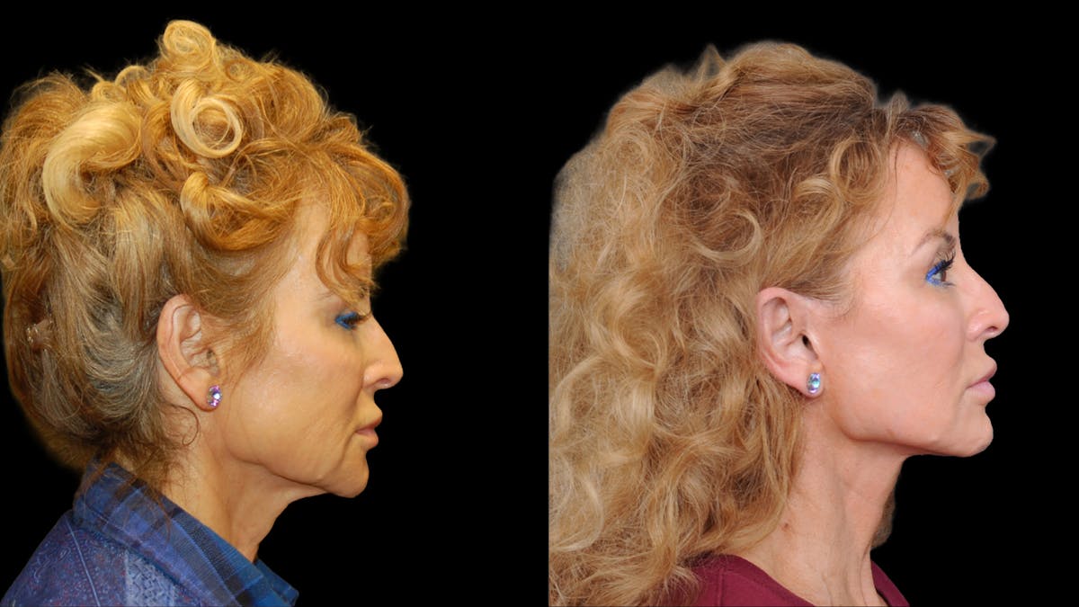 Deep Plane Facelift Before & After Gallery - Patient 154377 - Image 5