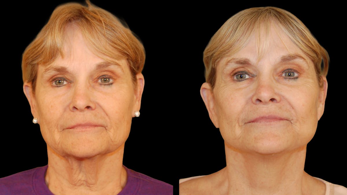 Deep Plane Facelift Before & After Gallery - Patient 372871 - Image 1