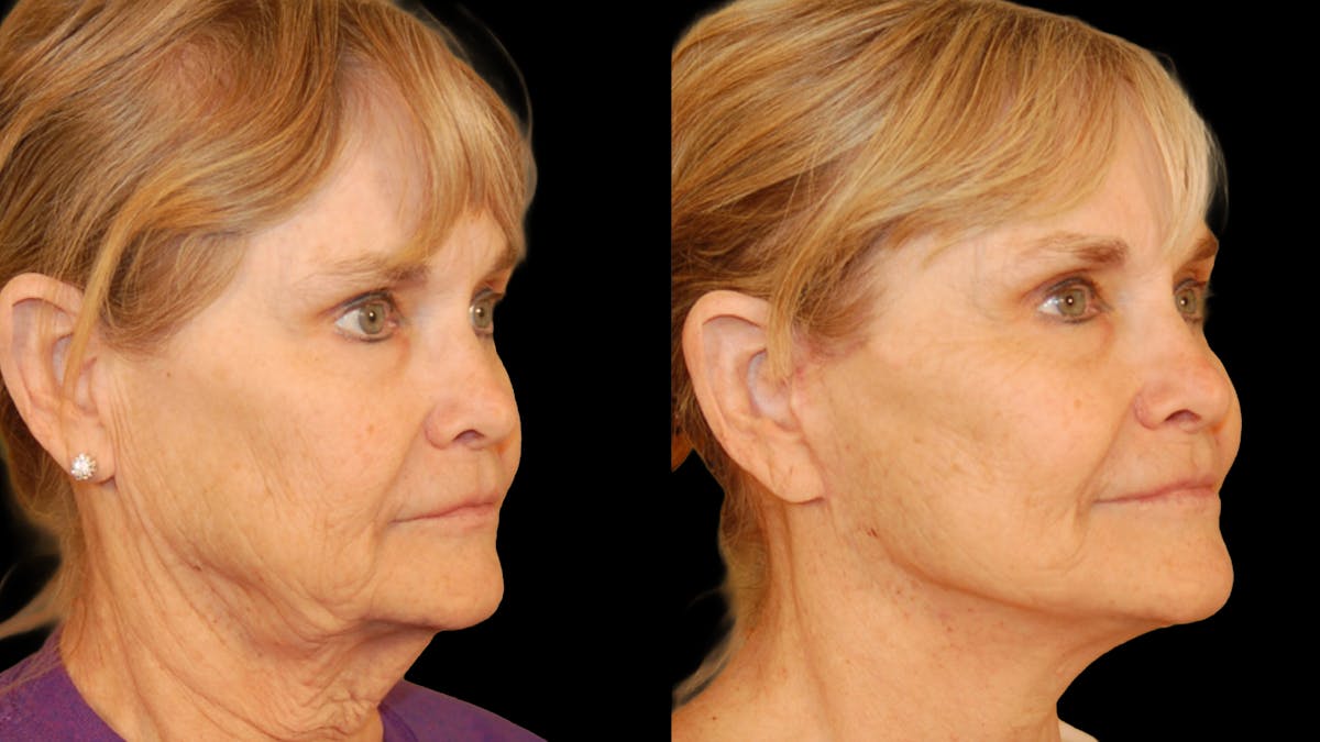 Deep Plane Facelift Before & After Gallery - Patient 372871 - Image 2