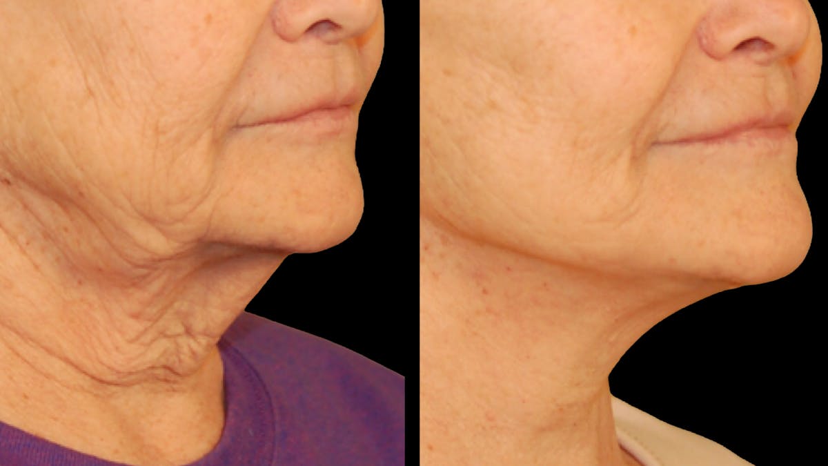 Deep Plane Facelift Before & After Gallery - Patient 372871 - Image 3