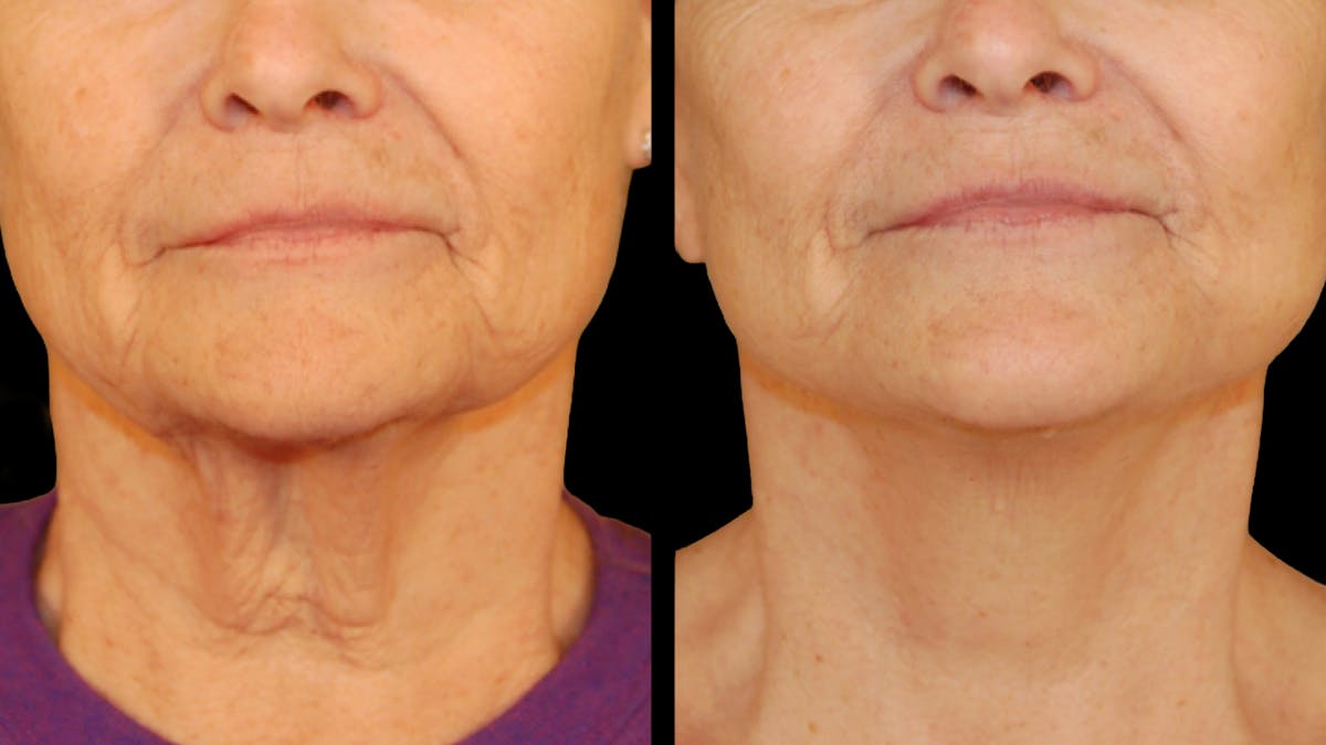 Deep Plane Facelift Before & After Gallery - Patient 372871 - Image 4