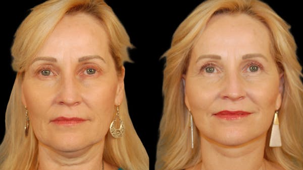 Neck Lift Before & After Gallery - Patient 234010 - Image 1