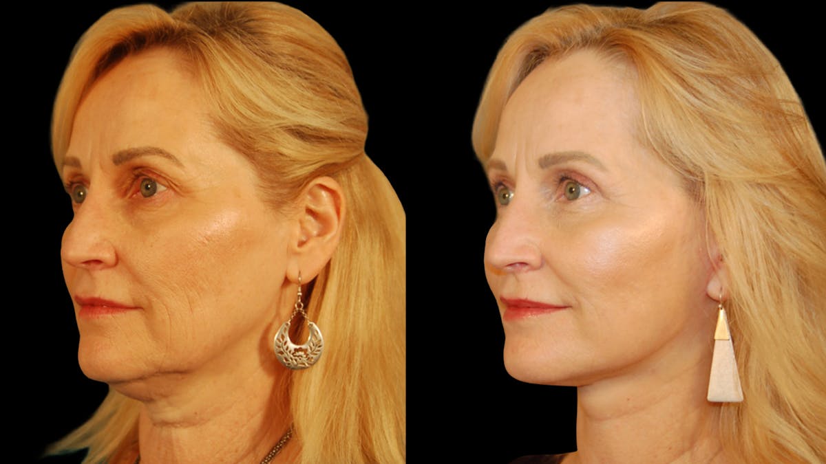 Neck Lift Before & After Gallery - Patient 234010 - Image 2