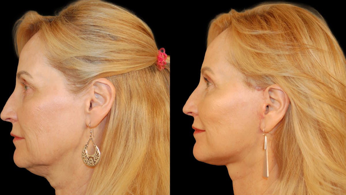 Neck Lift Before & After Gallery - Patient 234010 - Image 3