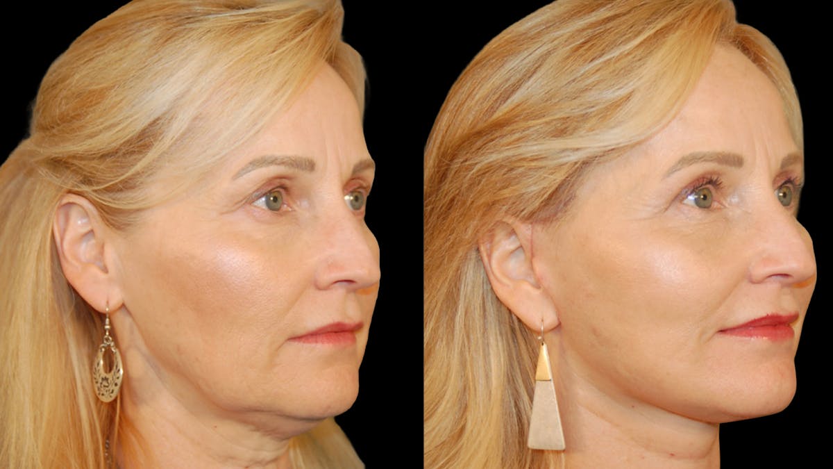 Neck Lift Before & After Gallery - Patient 234010 - Image 4